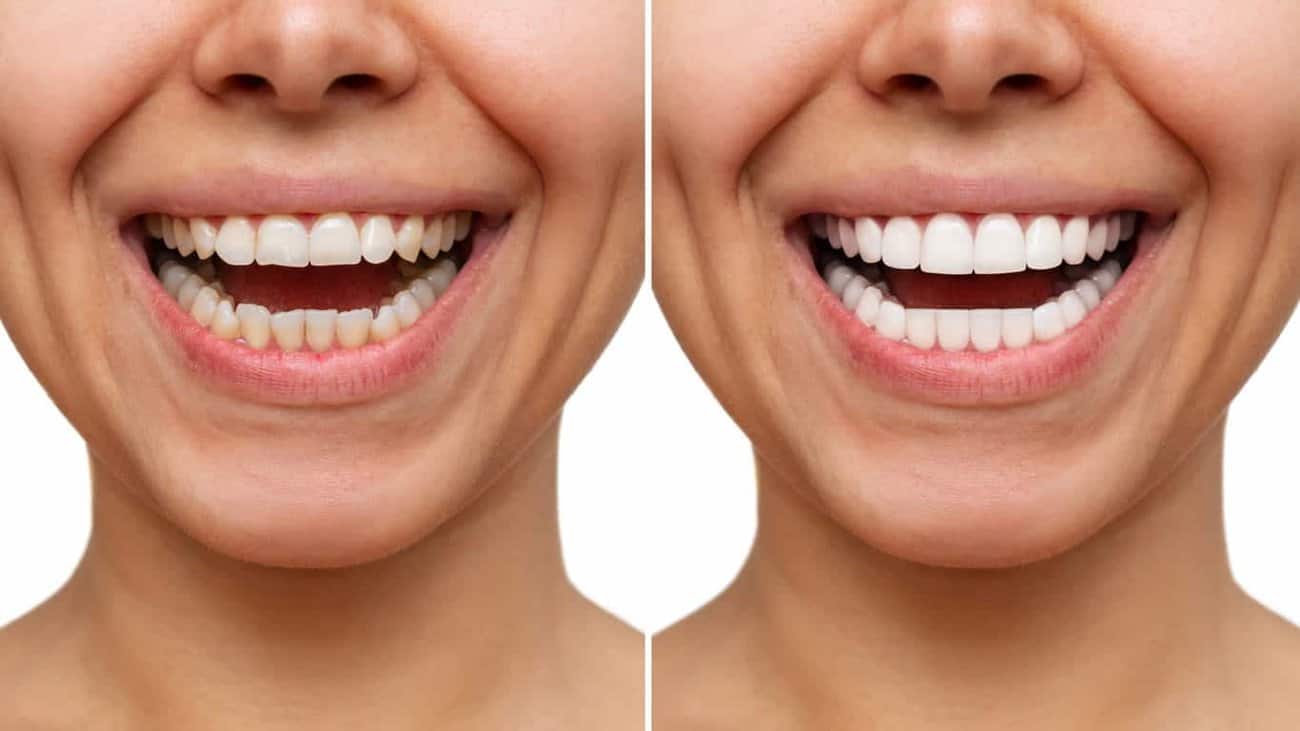 Instant results whitening