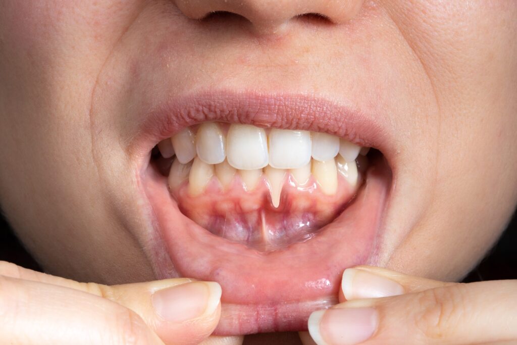 Preparing for teeth whitening with receding gums Milton Keynes